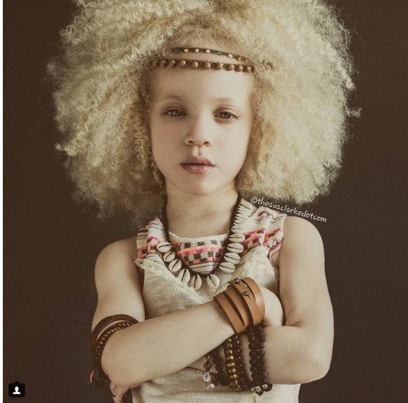 Девочка-альбинос стала моделью