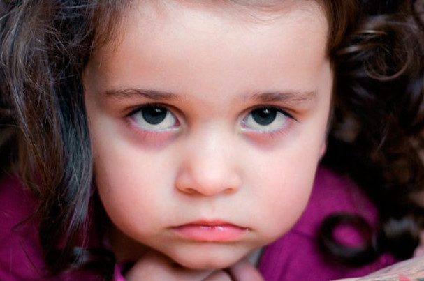 6 причин появления у ребенка кругов под глазами