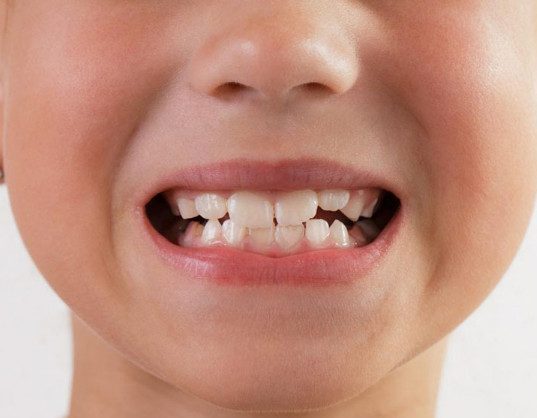 Как уберечь детские зубы от кариеса?