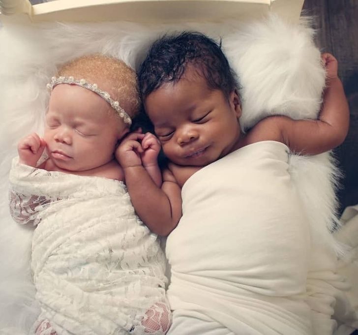 Близнецы с разным цветом кожи невероятно удивили свою маму при рождении