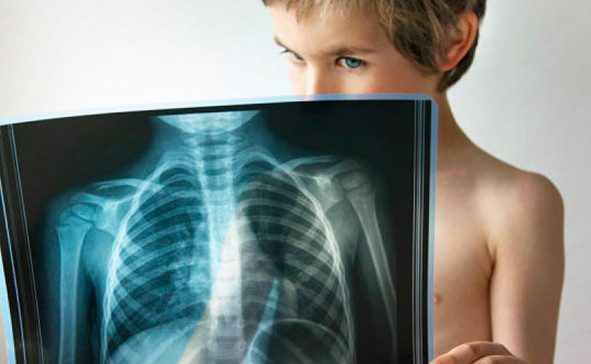 5 причин детского кашля: когда необходимо вести ребёнка на рентген?