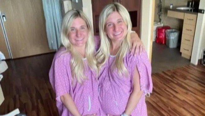 Однояйцевые близнецы родили с разницей в 2 часа