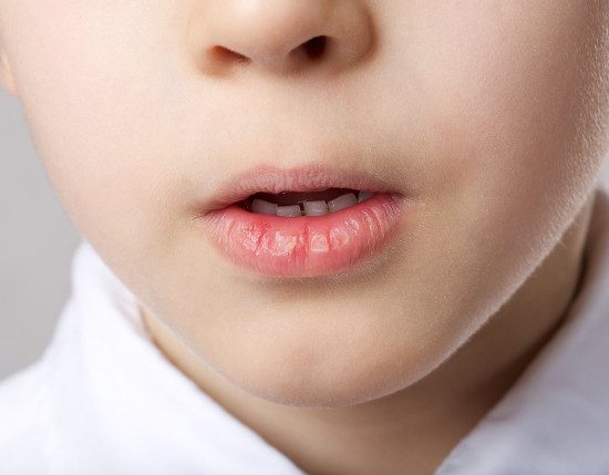 Почему у детей сохнут губы и что с этим делать?