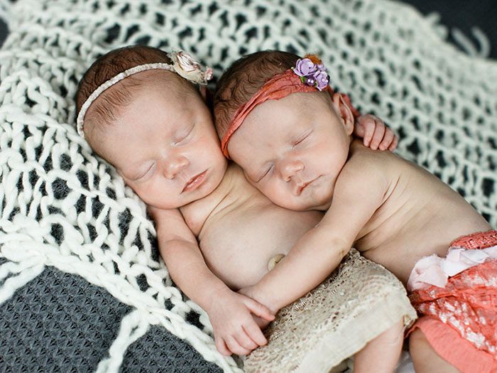 Трогательная история близнецов: держаться за руки с рождения
