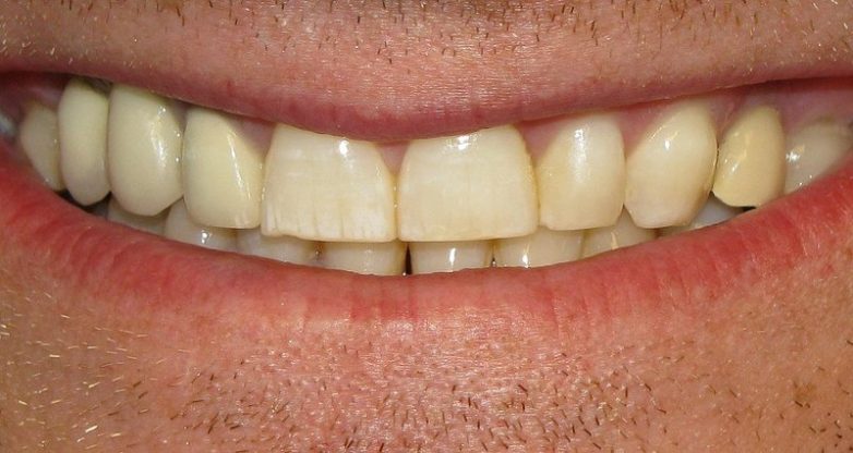 Вопрос на засыпку: почему зубы желтеют?