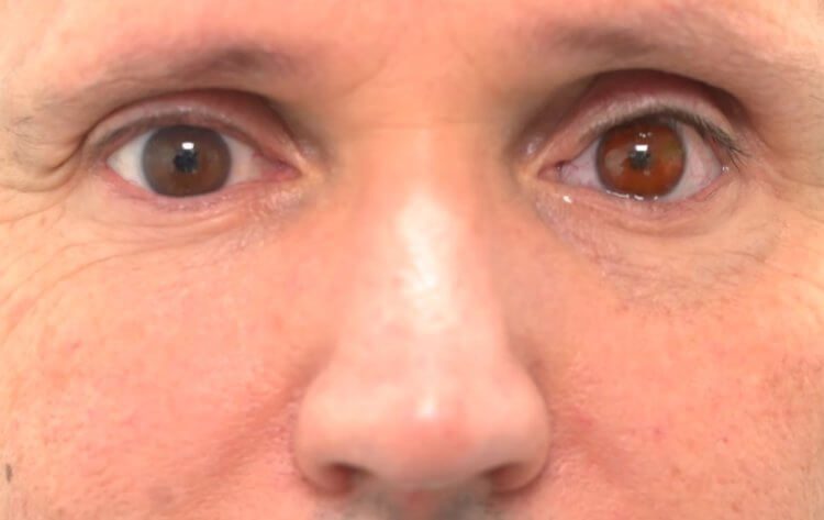 Как настоящий: мужчине имплантировали глаз, напечатанный на 3D-принтере