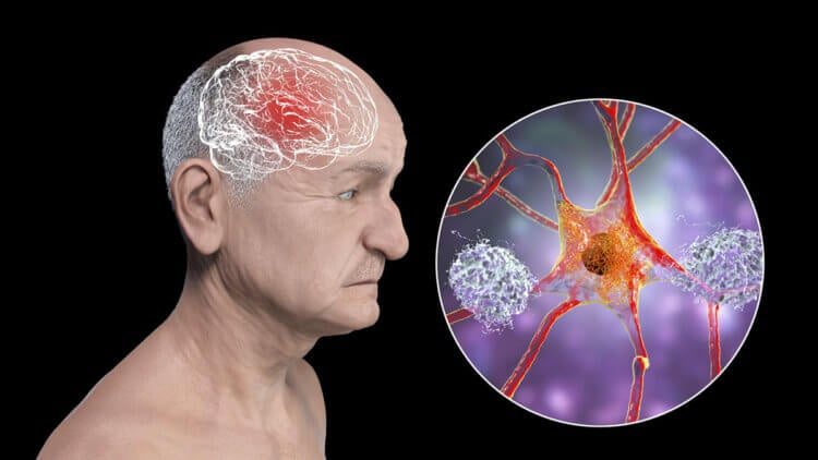 Вопрос на засыпку: болезнь Альцгеймера заразна?