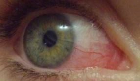 Лопнувший  глазной капилляр: причины, лечение