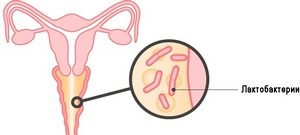 Бактериальный вагиноз: симптомы, причины, лечение