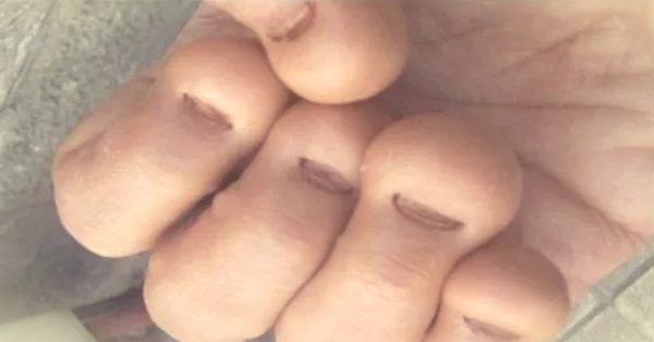 8 последствий вредной привычки грызть ногти