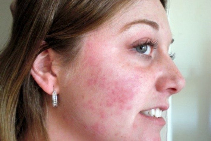 7 симптомов опасных заболеваний, которые «написаны» на лице
