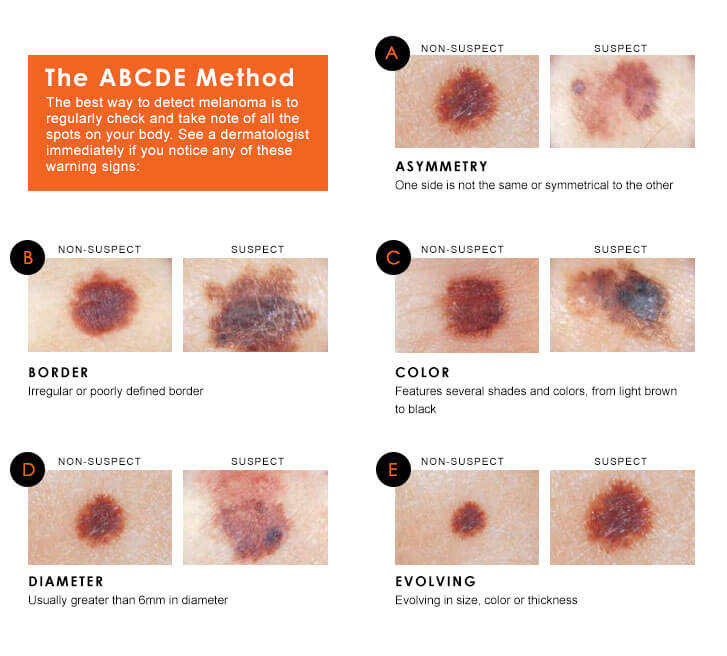 Как визуально определить рак кожи на ранней стадии?