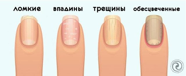 На какие проблемы со здоровьем может указывать состояние ваших ногтей?