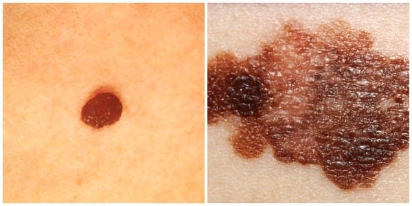 Как определить и предотвратить рак кожи