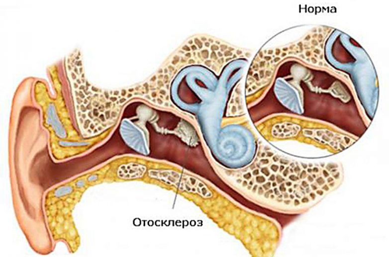 Что такое отосклероз и почему его трудно выявить