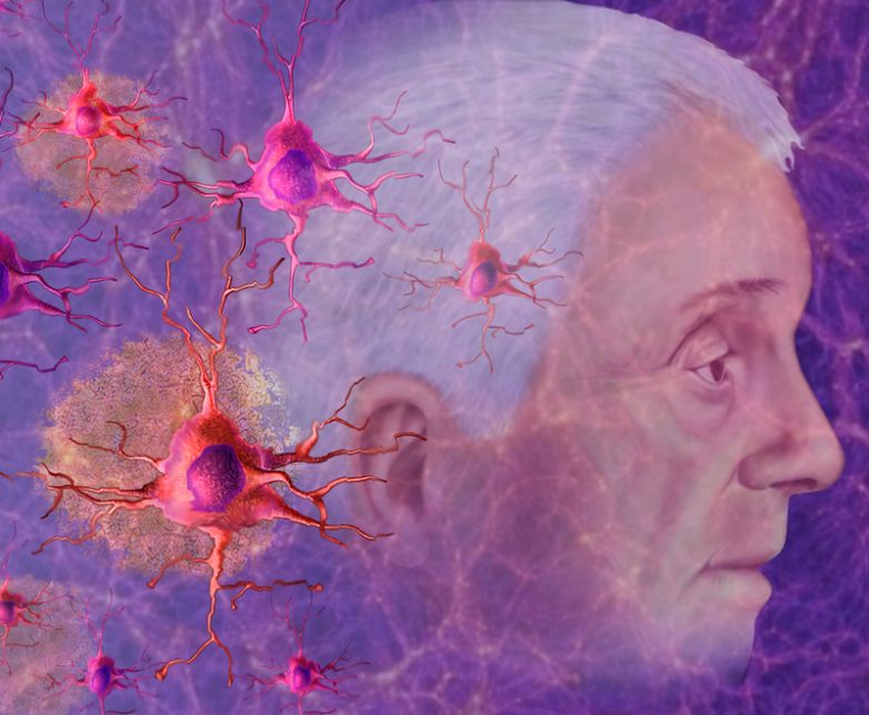 Как работает комбинация куркумина с витамином D в лечении болезни Альцгеймера