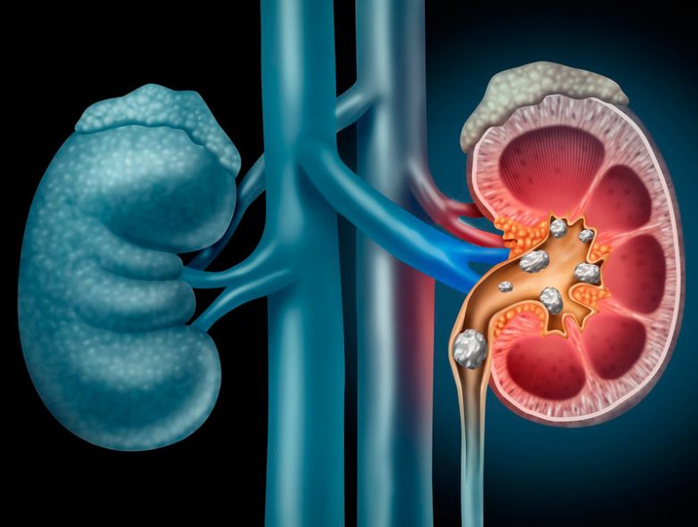 Как предотвратить камни в почках