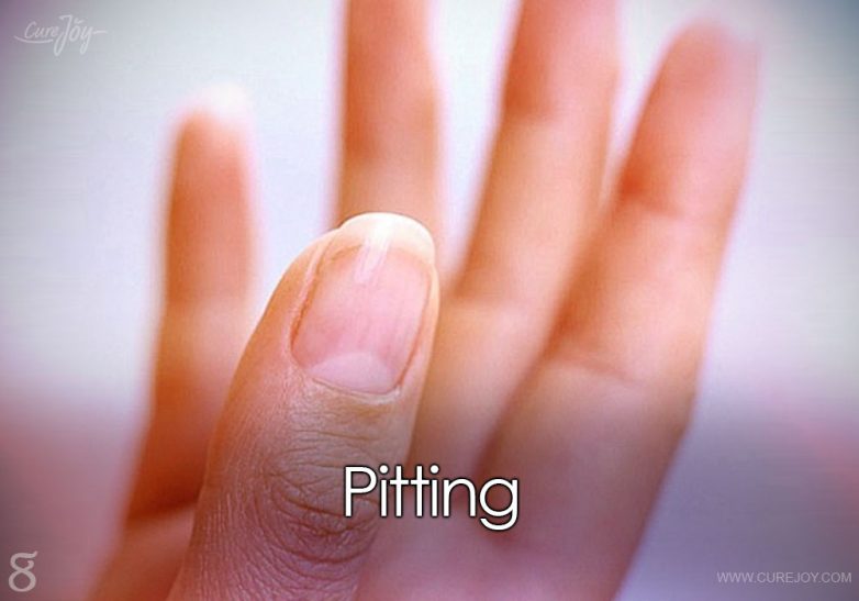 О каких болезнях нам расскажут ногти