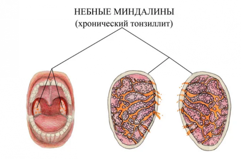 В чём опасность хронического тонзиллита