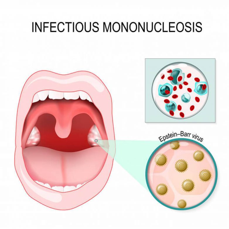 Главные признаки инфекционного мононуклеоза