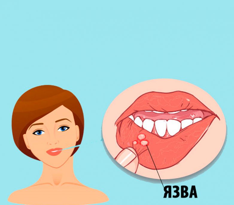 Язвы во рту: натуральные способы лечения