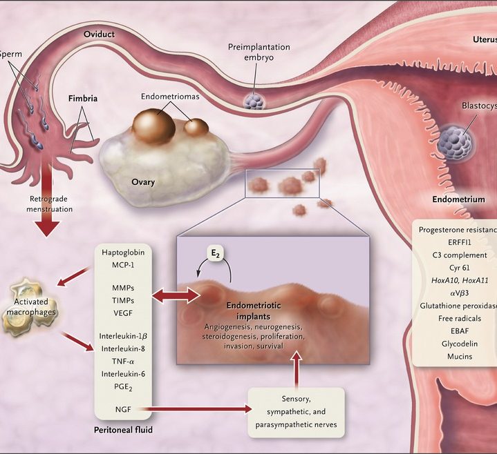 Эндометриоз и киста яичников. Женское здоровье