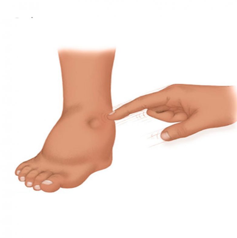 Причины и лечение отека ступней и лодыжек