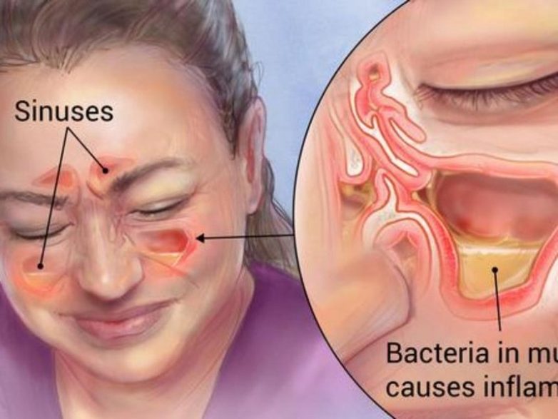 Правильное лечение синусита