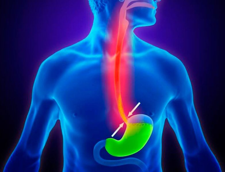 Причины, симптомы и опасность кислотного рефлюкса