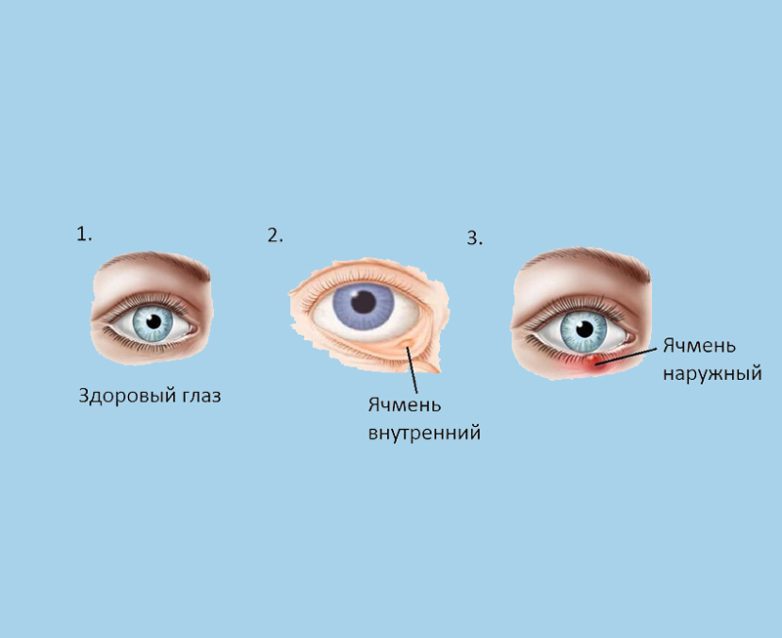 8 актуальных и безопасных способов борьбы. Ячмень на глазу