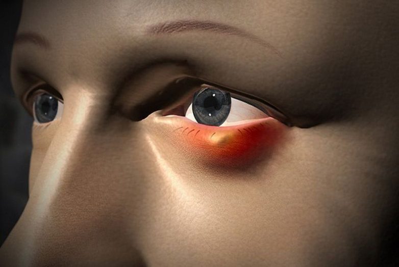 8 актуальных и безопасных способов борьбы. Ячмень на глазу