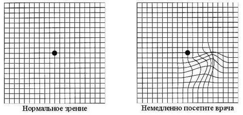 Как вовремя выявить заболевание глаз. Тест Амслера