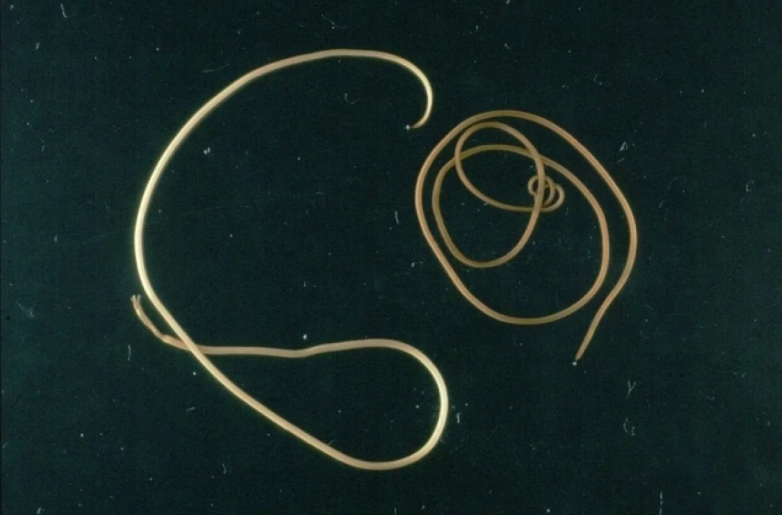 Как в глаз жительницы Омска попал живой червь