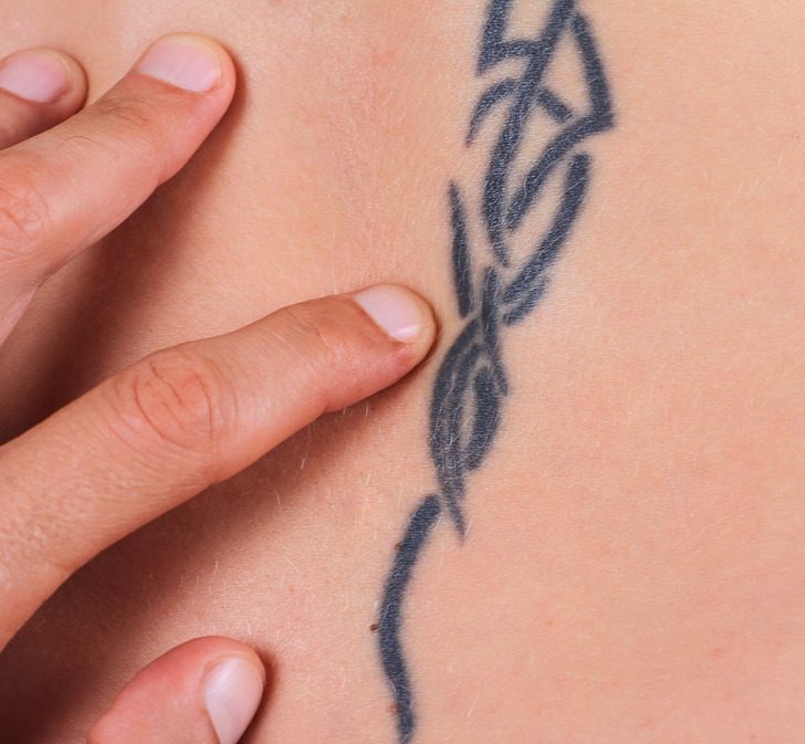 Всё, что следует знать об удалении татуировок