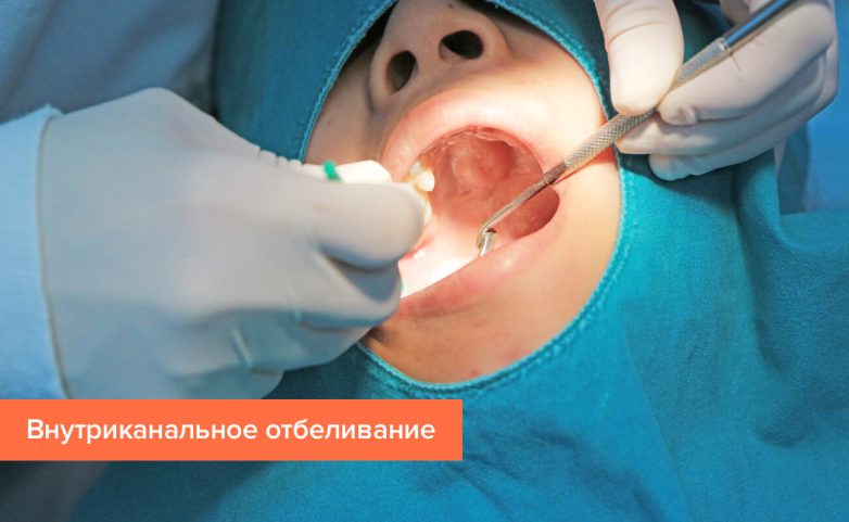 Отбеливание зубов: виды процедур, плюсы и минусы