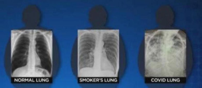 Насколько лёгкие больного COVID-19 хуже лёгких здорового человека и курильщика
