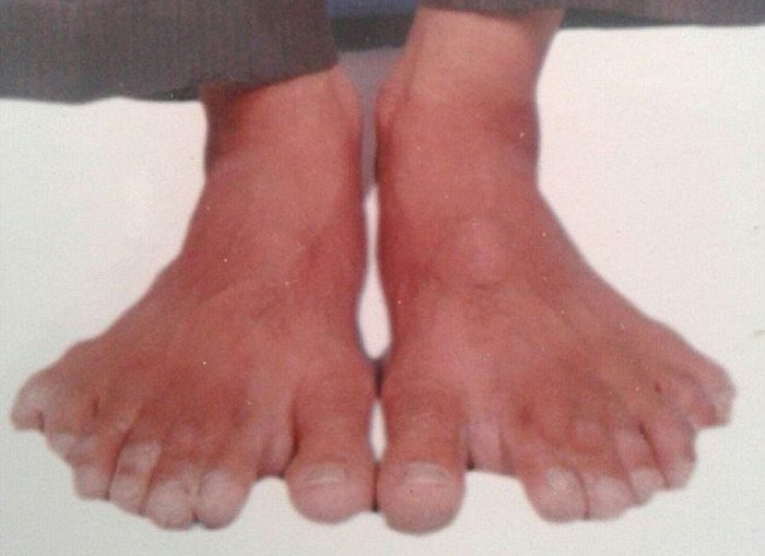 Этот индиец - рекордсмен мира по количеству пальцев на руках и ногах