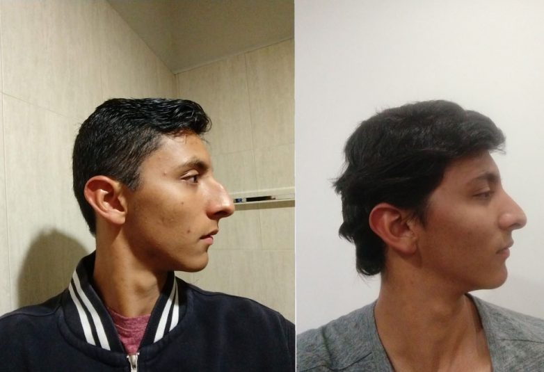 The weekend операция до и после фото