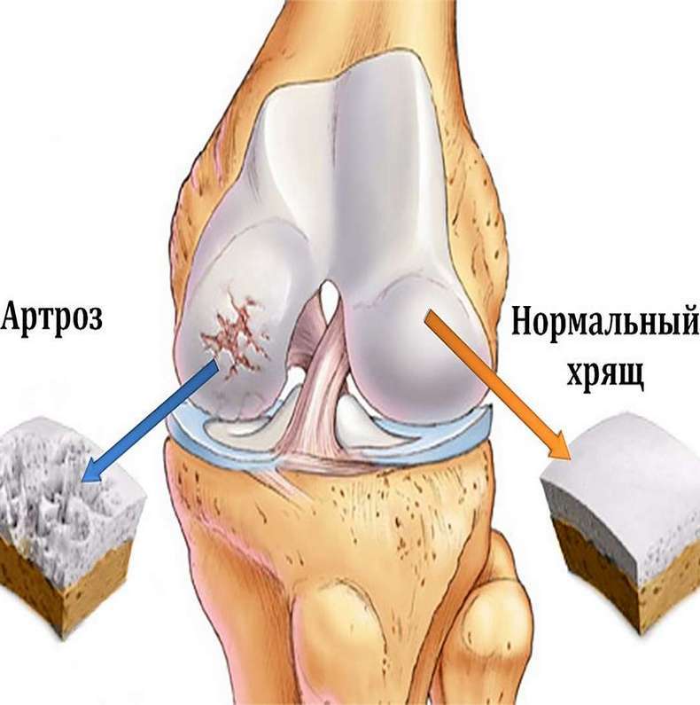 Гонартроз коленного сустава что. Артроз коленного сустава. Артроз коленного счуст АВ. Ортроз коленного сустав. Остеоартроза коленного сустава.