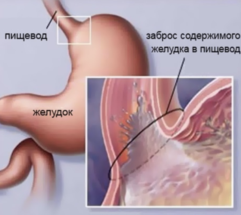 Изжога причины. Рефлюкс-эзофагит изжога\. Гастроэзофагеальный рефлюкс с эзофагитом. Рефлюкс-эзофагит, синдром Золлингера.