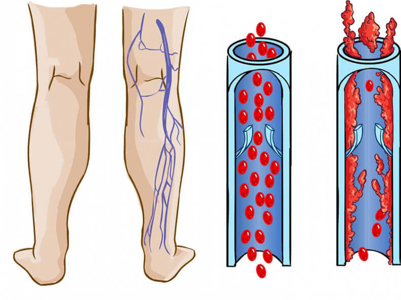 Тромбоз глубокой вены. Тромбоз икроножных вен. Посттромбофлебитический синдром и варикоз. Тромбоз подколенной вены. Тромбофлебит сосудов нижних конечностей.